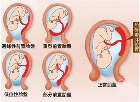 隱藏性胎盤剝離|醫砭 » 疾病庫 » 胎盤早剝